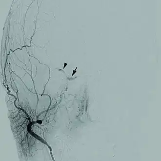 Description de l'image 1471-2415-12-28-1Cerebral angiogram.jpg.