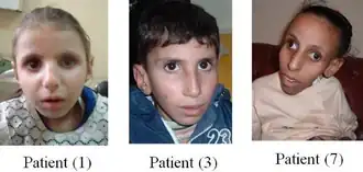 Description de l'image 3-patients-with-cockayne-syndrome.webp.