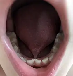 Ankyloglossie chez un enfant de 4 ans.