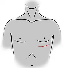 Thoracotomie antérieure gauche.