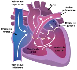 Schéma d’un cœur présentant une atrésie tricuspide.
