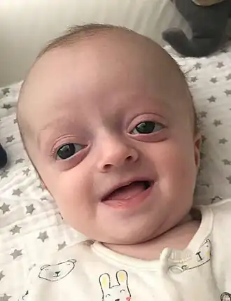 Description de l'image Baby with Crouzon Syndrome.jpg.