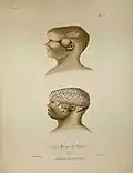 Planche anatomique, intitulée « Hernie du Cerveau », constituée de deux peintures. La première représentant un crâne humain, aplatie sur le sommet, avec une hernie située entre la tempe et l’oreille. La deuxième peinture représente le même crâne, mais dont la peau et les os ont été retirés pour voir le cerveau.