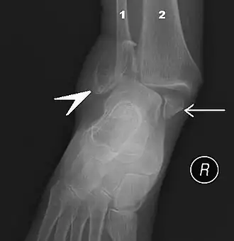 Fracture bimalléolaire de la cheville.