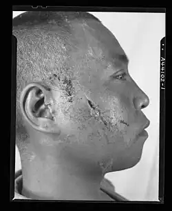 Blessure à la face par éclat de mortier (Seconde Guerre mondiale).