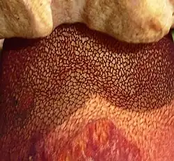 Réseau rouge fin et net du Bolet cuivré (Imperator luteocupreus)