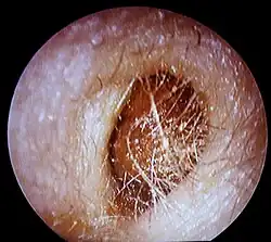 Bouchon de cérumen complet dans le conduit auditif