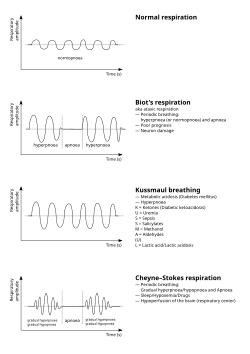 (en) Respiration de Kusmaul