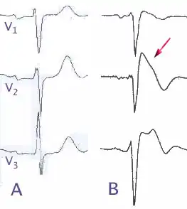 Comparaisons d'electrocardiogrammes (dérivations précordiales) chez