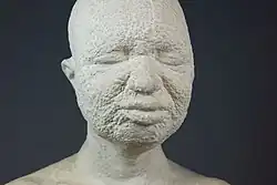 Buste d'un homme probablement atteint de la variole.