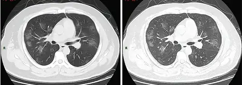 Stade 2 (progressif)