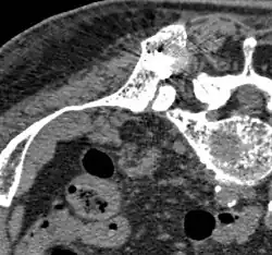 Après ablation, la répartition du ciment dans l'espace vide est visible.