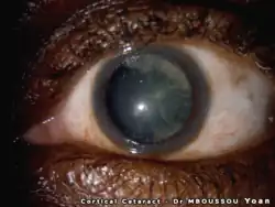 Vue d'une cataracte corticale à l'examen de lampe à fente