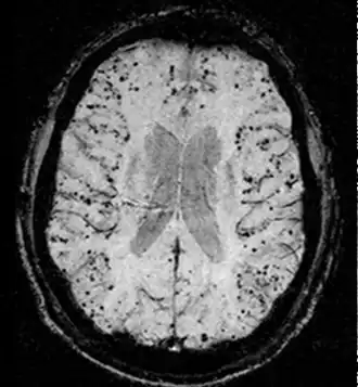 Description de l'image Cerebral amyloid angiopathy (CAA)-MRI.png.