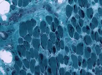 Description de l'image Congenital nemaline myopathy.jpg.