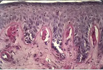 Description de l'image Cutaneous histological features of EPP.jpg.