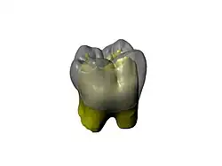 Reconstruction virtuelle d'une dent