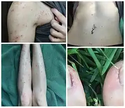 quatre images d'une même patiente, épaule gauche, ventre, faces antérieures des jambes, hallux présentant un semis de petites lésions d'excoriation
