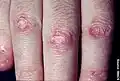papules de Gottron avec atrophie importante, cicatrice blanche et telangiectasie