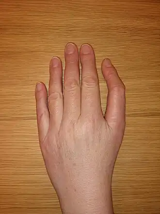 Description de l'image Dreigliedriger Daumen.jpg.