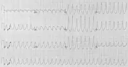 Image illustrative de l’article Tachycardie