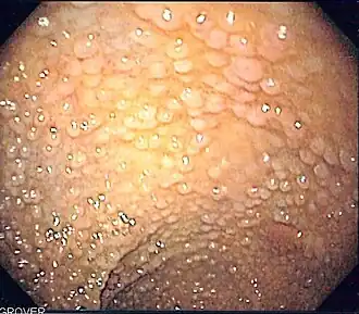 Description de l'image Familial adenomatous polyposis as seen on sigmoidoscopy.jpg.
