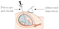 fœtoscopie