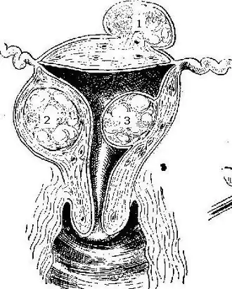 Description de l'image Fibroid.jpg.