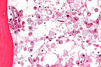 Description de l'image Gaucher_disease_-_very_high_mag.jpg.