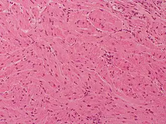 Description de l'image Granular cell tumor Case 174 (5600864519).jpg.