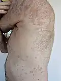 Psoriasis en gouttes sur un homme de 66 ans.