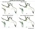 Schémas quantifiant l'hyperhidrose axillaire.