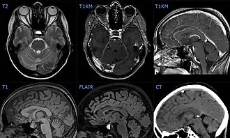 Description de l'image Hypophyseninfarkt mit Einblutung 44W - MR CT - 001 - Annotation.jpg.
