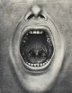 Bouche avec dents extraites (The Defective Delinquent and Insane par Henry Cotton ; 1921).