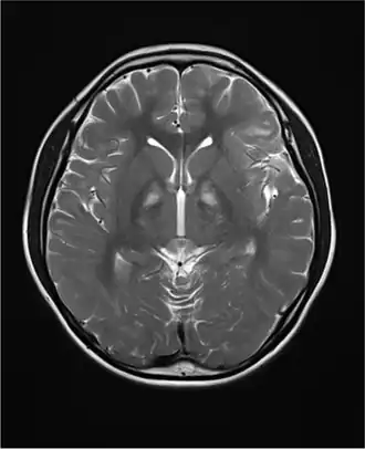 Description de l'image Kearns–Sayre syndrome.webp.