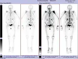 Scintigraphie corps entier avec 99mTc-HDP de la patiente avec une fracture du bras due à une métastase du cancer du sein