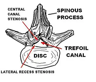 Description de l'image LUMBAR TREFOIL CANAL.JPG.