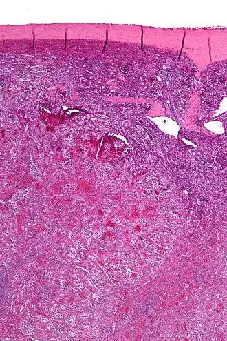 Description de l'image Littoral cell angioma of the spleen - low mag.jpg.