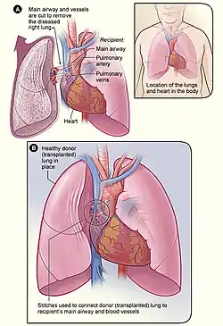 Description de l'image Lung_transplant.jpg.
