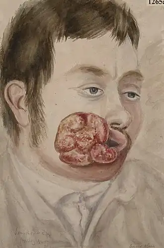 Description de l'image Man with extensive epithelioma at the corner of the mouth Wellcome L0062414.jpg.