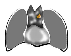 Dessin représentant un thymome stade IIb.