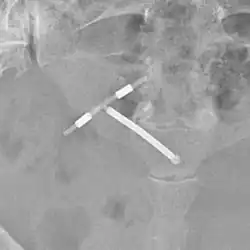 Dispositif médical en forme de T, plus blanc que les autres structures