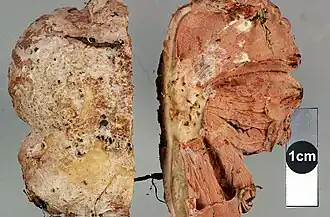 Hôte parasité par Mycogone rosea coupé en deux, vue externe et interne (Nouvelle-Zélande).