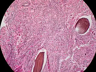 Description de l'image Myelofibrosis, Reticulin Stain (6032644716).jpg.