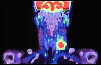 Description de l'image PET-CT scanning of lymph node metastases in cancer 2.jpg.