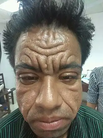 Description de l'image Pachydermoperiosteosis image.jpg.