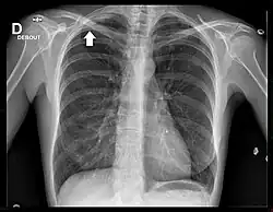 Radiographie pulmonaire de face où une tumeur difficilement visible est repérée d'une flèche.