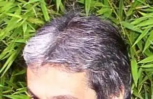 Description de l'image Piebaldisme.jpg.