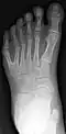 Radiographie de face du pied gauche d'un enfant atteint de polydactylie.