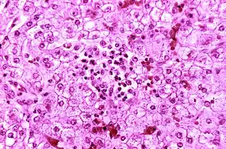 Description de l'image Reye's syndrome liver-histology.jpg.